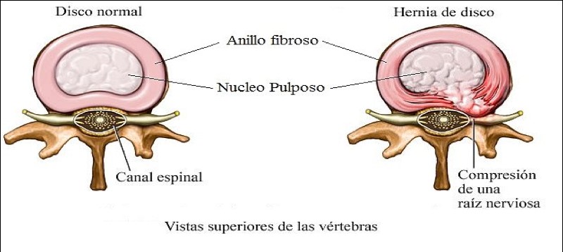 hernia discal lumbar